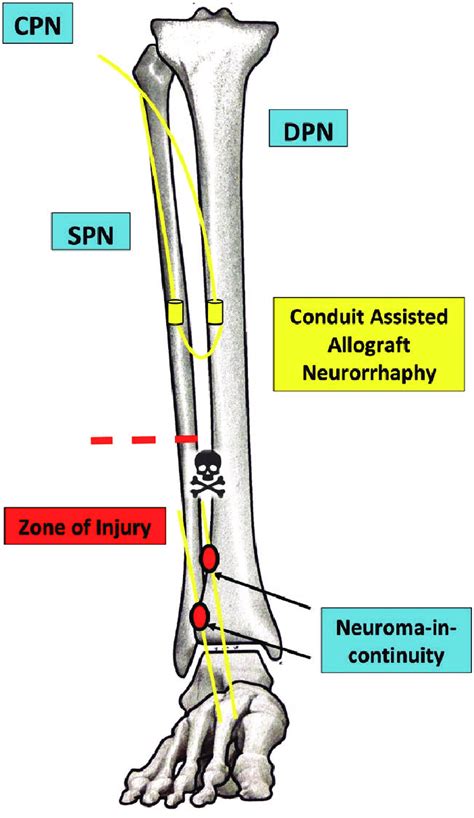 Spn To Dpn Neurorrhaphy Performed Proximal To The Zone Of Injury And
