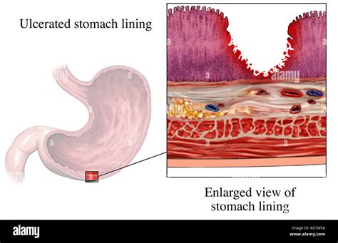 What Causes Gastric Stomach Ulcers Cedars Sinai Images