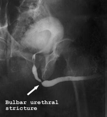 Urethral Strictures In Males Practice Essentials Relevant Anatomy