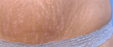 How To Reduce The Appearance Of Stomach Stretch Marks Innovations Medical