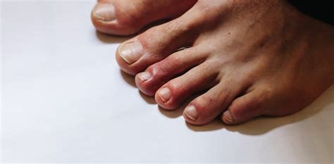 8 Ways The Coronavirus Can Affect Your Skin From Covid Toes To Rashes