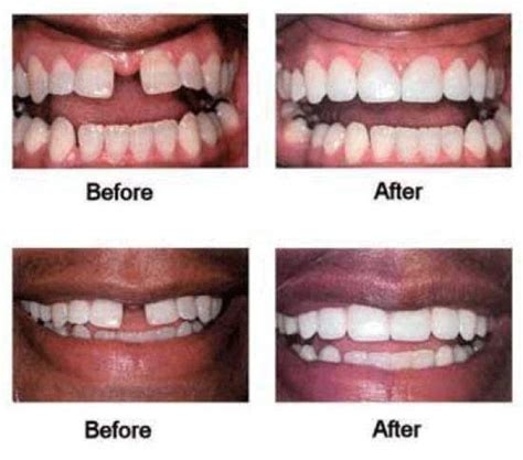 Fix Gaps Between Teeth With Corrective Treatments Oral Care Blog