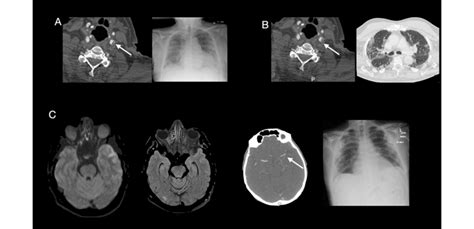 Case 5 A Ct Angiography Demonstrates Lobulated Soft Tissued Plaque At