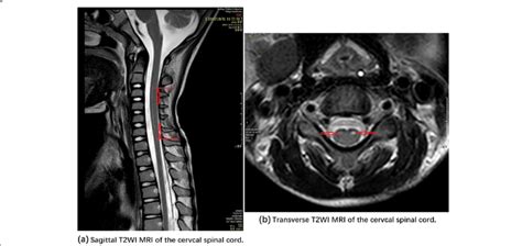 Sagittal And Transverse T2wi Mri Of The Cervical Spinal Cord Note