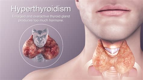 Hyperthyroidism Scientific Animations
