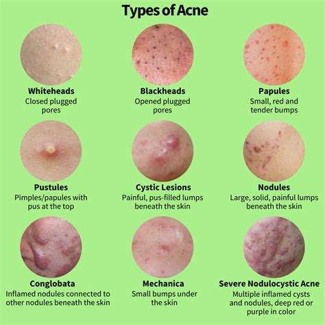 All About Acne Part 1 The Causes Picky The K Beauty Hot Place