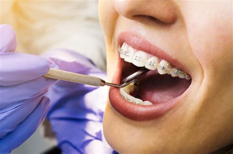 Intrusión Dental En Ortodoncia ¿qué Es Y Cuándo Está Indicada