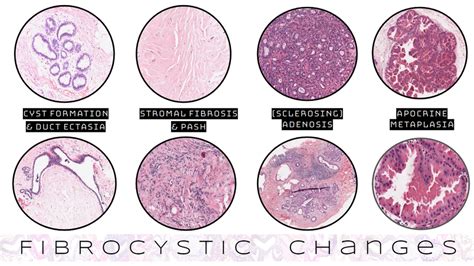 High Yield Breast Pathology Fibrocystic Changes