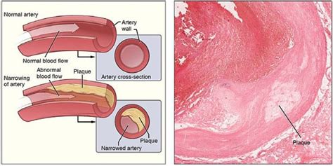 Researchers Learn How Bad Cholesterol Enters Artery Walls To Promote