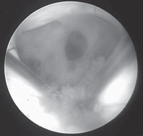 Endoscopic Picture Showing Fenestration Of The Septum Pellucidum After