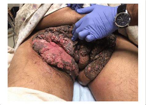 Condyloma Acuminata Of The Groin And Pelvic Region Disfiguring The Male