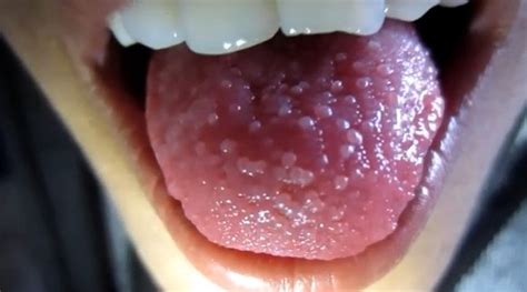 Swollen Inflamed Taste Buds Symptoms Causes Pictures Treatment