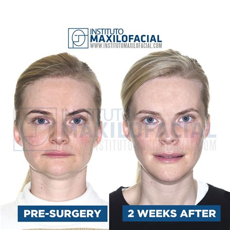 Contouring Of The Mandible Maxillary Advancement Corrective Jaw Surgery