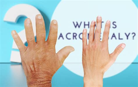 acromegaly what is acromegaly diagnosis symptoms and causes