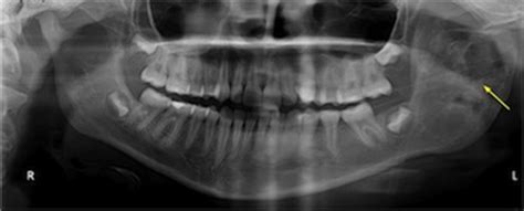 Aneurysmal Bone Cyst Jaw