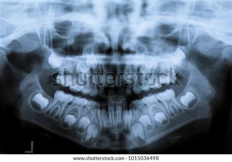 Baby Teeth Panoramic Xray