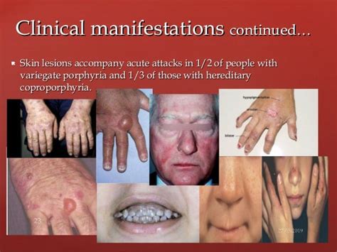 Porphyria Pictures