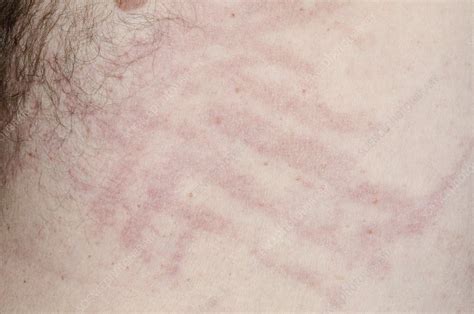 Urticaria Stock Image C0150357 Science Photo Library