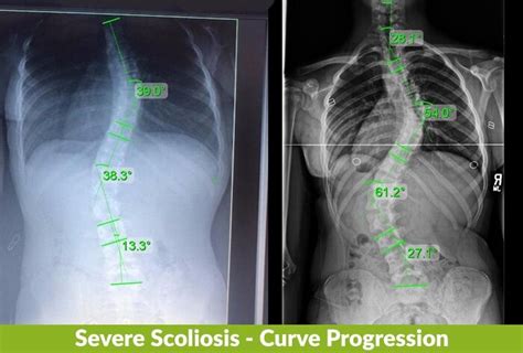 Scoliosis Curve Classification My Xxx Hot Girl