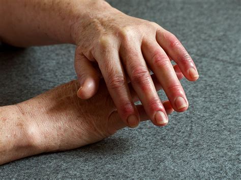 Artritis En Los Dedos ¿cómo Se Siente Causas Y Tratamiento