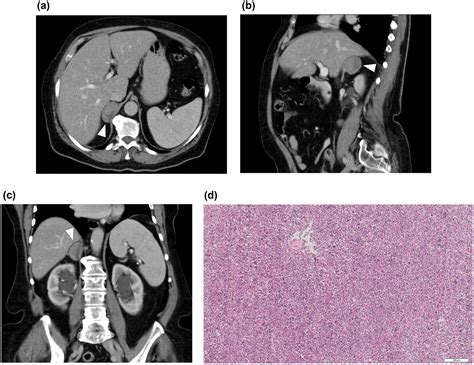 Spleno Adrenal Fusion Mimicking An Adrenal Metastasis Of A Renal Cell