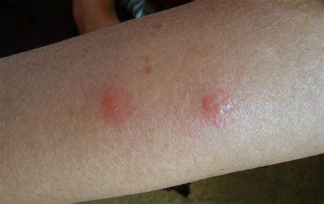 Papular Urticaria Pictures Causes Treatment Symptoms