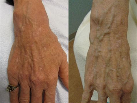 When And Why Do Hand Veins Become More Obvious Denver Vein Center