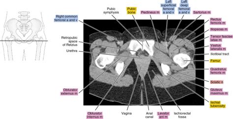 Female Pelvis Ct Scan Hot Sex Picture