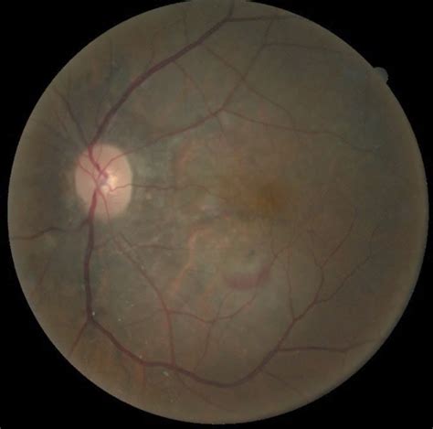 Systemic And Ocular Associations Of Angioid Streaksa Teaching Case