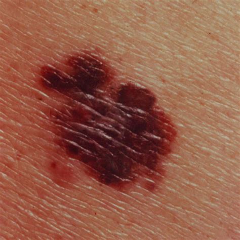 What Does Melanoma Look Like Images And Symptoms