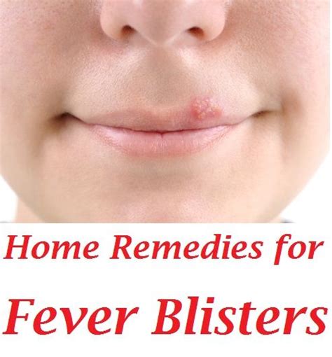 26 Best Fever Blisters Cold Sores Home Remedies Causes And Symptoms