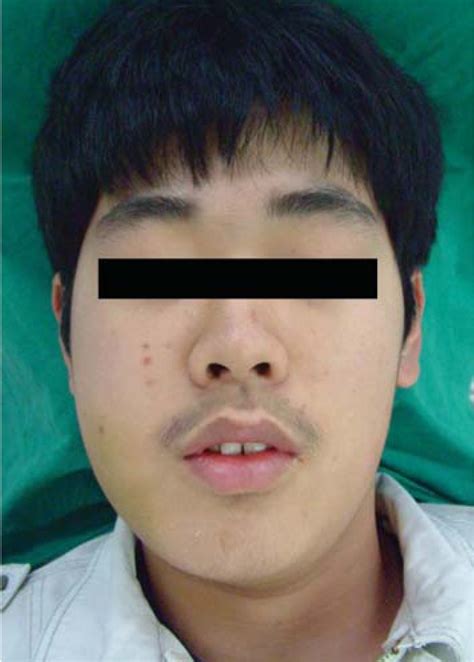 Extraoral Photograph Shows A Swelling On The Right Cheek Causing Facial