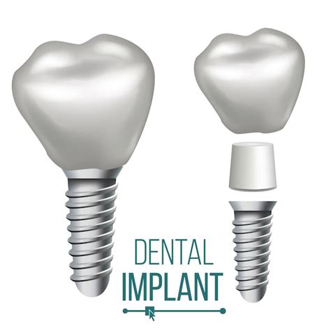 Ilustración De Implante Dental Vector Premium