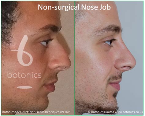 Equally, the need to resort to plastic surgery for traditional rhinoplasty is perhaps not an attractive prospect either. Non-surgical Nose Job Male - botonics