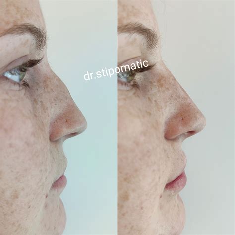 Non Surgical Nose Job Maticlinic Aesthetics ǀ Anti Wrinkle Injections ǀ Dermal Fillers
