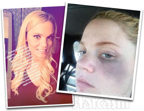 90 Day Fiance Ashley Martson Shares Abuse Photo Hysterectomy Story