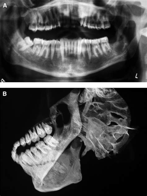 Primary Intraosseous Carcinomas Of The Jaws Arising Within An