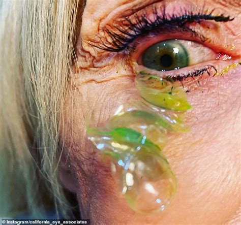 Painful Oversight Gruesome Video Shows Woman Having 23 CONTACT LENSES