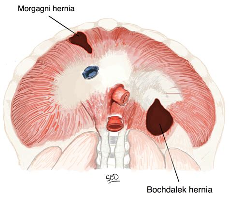 Cureus Diaphragmatic Hernia Repair Using Biosynthetic Tissue