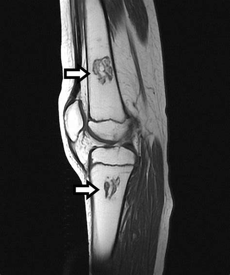 Osteonecrosis Avascular Necrosis Of Knee And Tibia The Journal Of