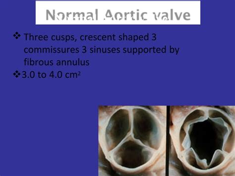 Echo Assessment Of Aortic Valve Disease Dr Ferdous Assistant Registrar Cardiology Dhaka