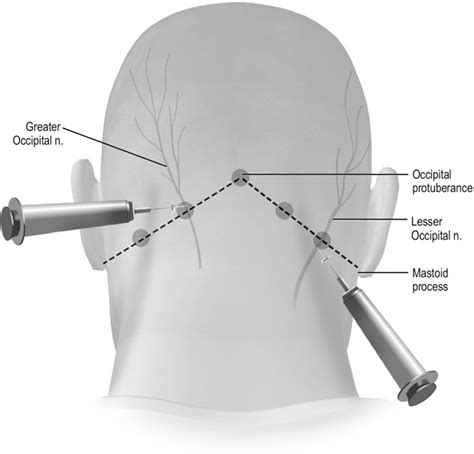 Nerve Block For Migraine Headaches Treatment Doctorvisit