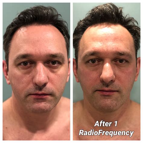 Radio Frequency Skin Tightening Uplift Spa