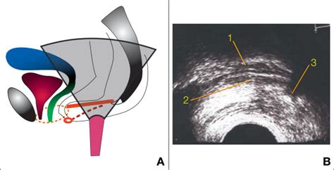 Figure 2 Retro Anal Ultrasound Of The Levator Plate A