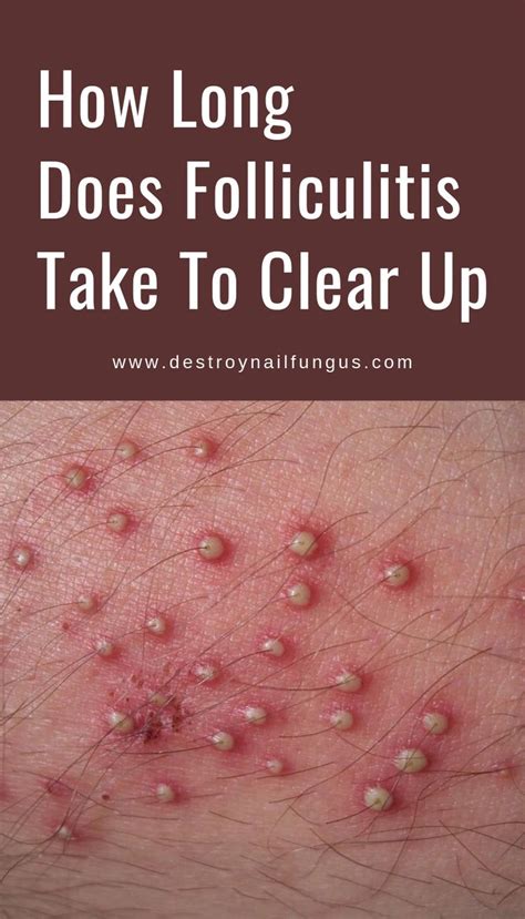 Folliculitis Is A Common Skin Condition That Leads To Itchy Sometimes