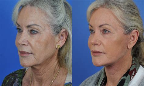 Case Study For Face And Neck Lift In San Diego Ca