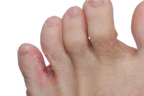 Athlete's foot is a highly contagious fungal infection that is part of a larger family of fungal infections affecting the skin and nails. Home Remedies for Athlete's Foot | Toenail fungus remedies ...