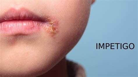 Impetigo In Children Causes Symptoms Diagnosis And Treatment