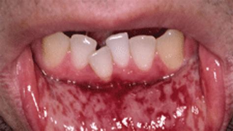 Oral Lesions In Images