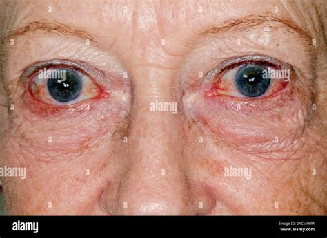 Bulging Eyes Proptosis Or Exophthalmos In A 79 Year Old Female